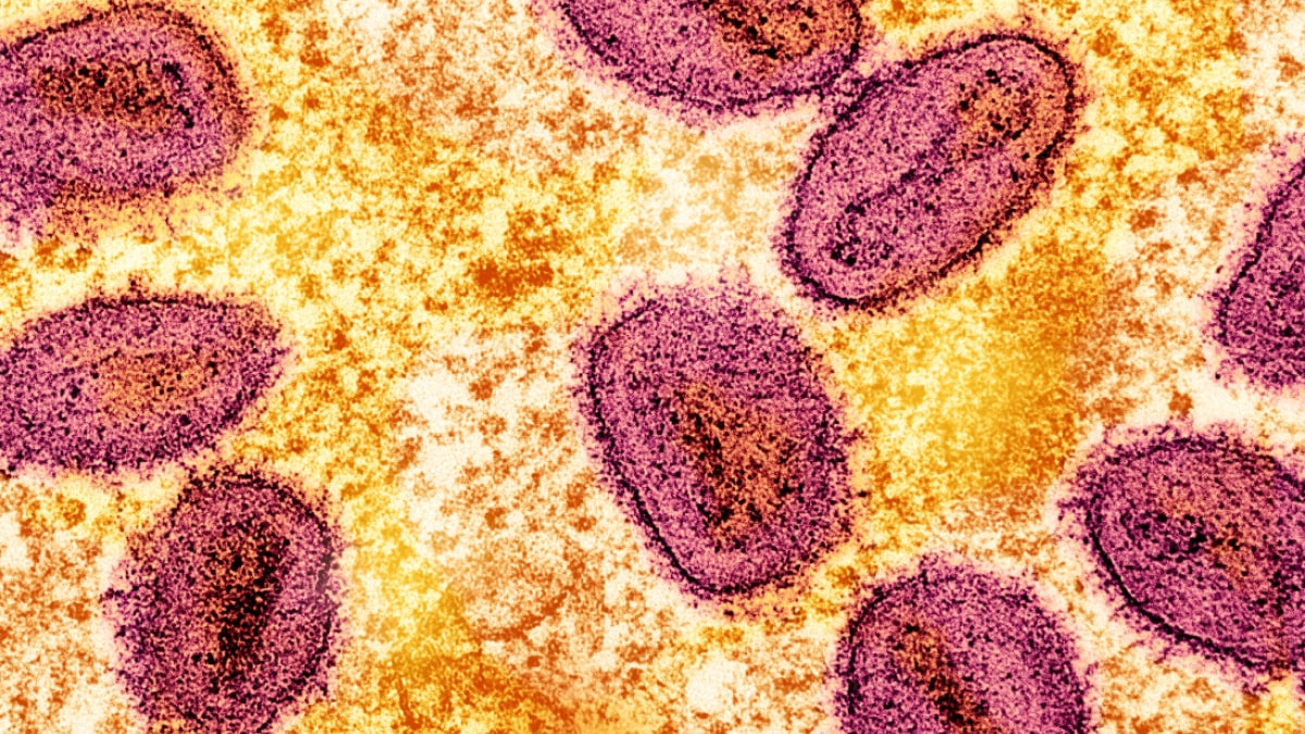 mpox-new-strain-spotted-in-sweden,-marks-the-first-case-outside-of-africa